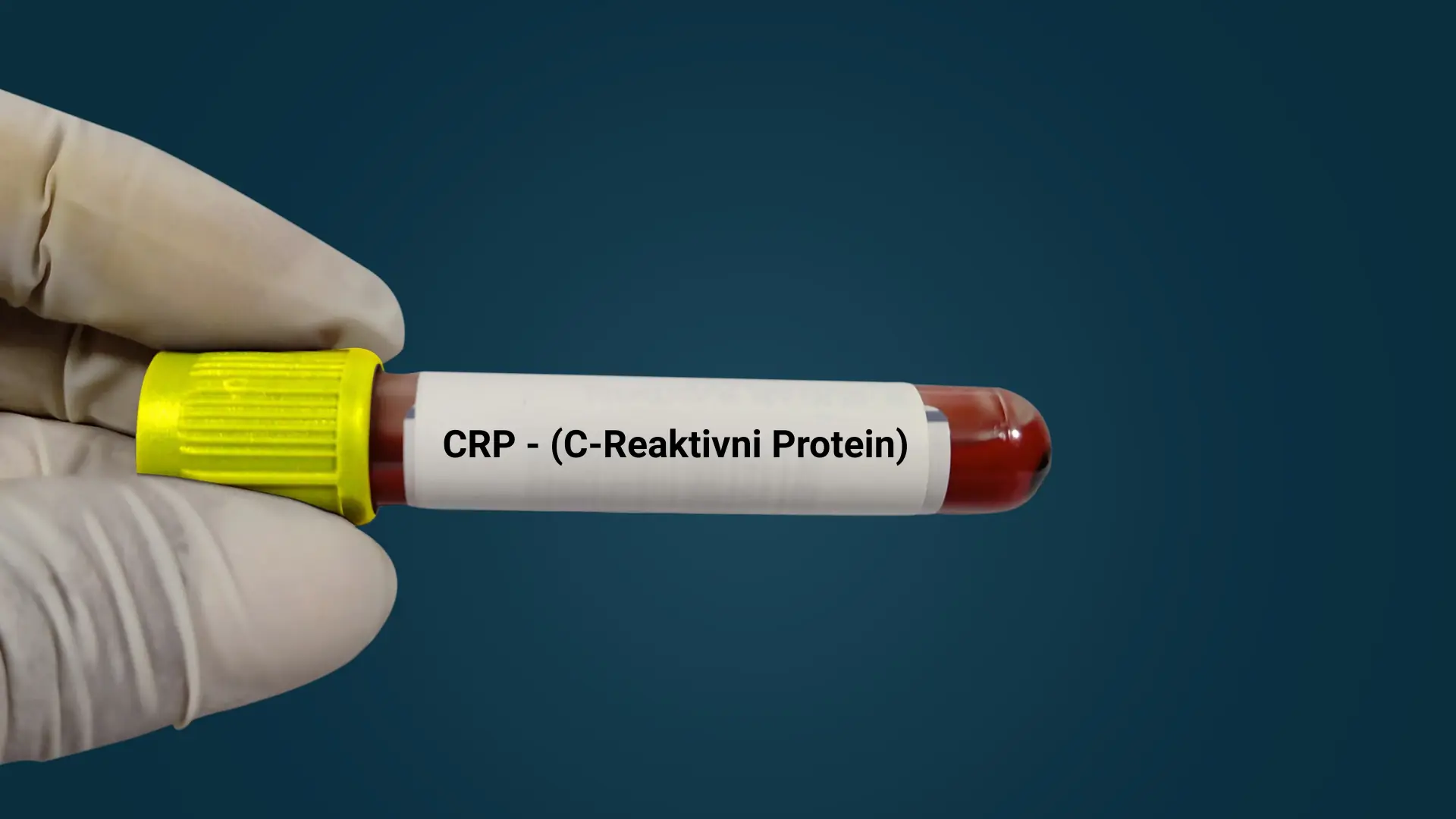 CRP (C-reaktivni protein): Brz i pouzdan pokazatelj upale